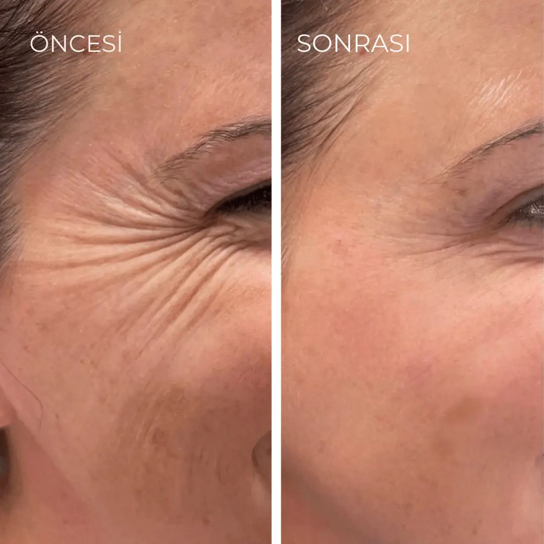 Korenlea™ Beauty Kolajen Bandı