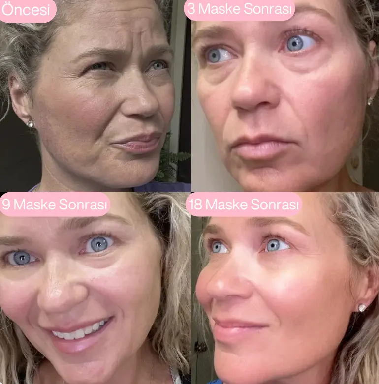 Koreanlea 3D Lifting Sıkılaştırıcı Botoks Etkili Maske